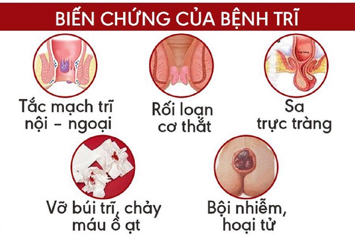 Triệu chứng nhận biết trĩ hỗn hợp
