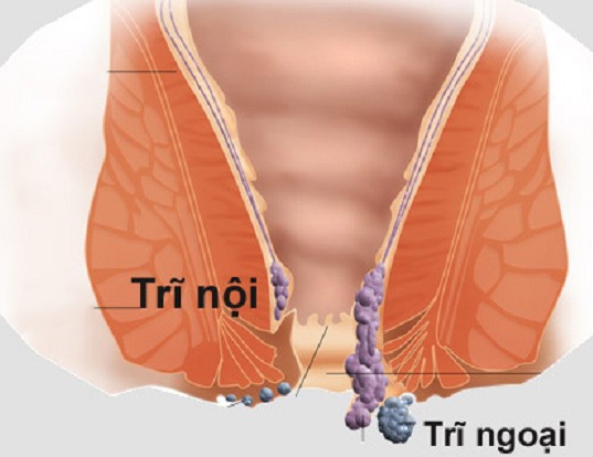 Dấu hiệu nhận biết trĩ ngoại