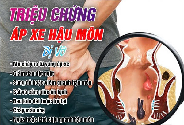 Triệu chứng của áp xe hậu môn