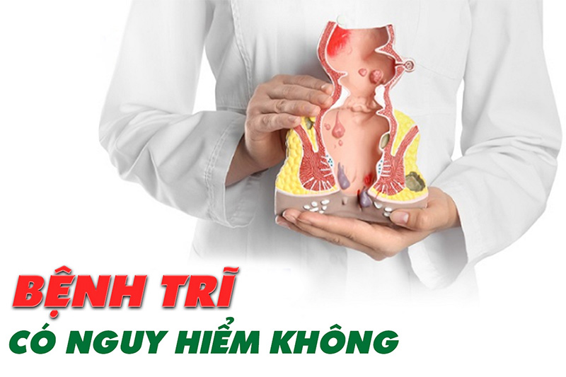 Tổng Quan Bệnh Trĩ