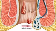 Nguyên nhân gây ra trĩ hỗn hợp