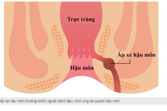 Nguyên nhân gây áp xe hậu môn